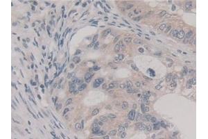 Detection of FIS1 in Human Colorectal cancer Tissue using Polyclonal Antibody to Fission 1 (FIS1)