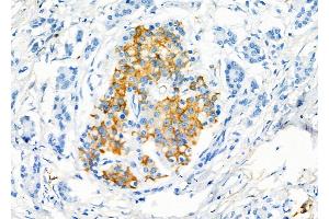 ABIN6265697 and ABIN6277021 at 1/100 staining Human gastric cancer by IHC-P.