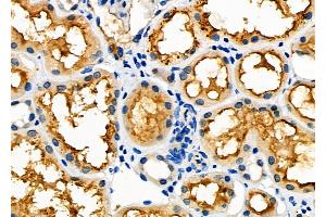 ABIN6265906 and ABIN6277616 at 1/100 staining Human kidney cancer and adjacent normal tissues by IHC-P. (UROD 抗体  (C-Term))