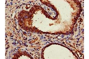 Immunohistochemistry of paraffin-embedded human prostate cancer using ABIN7150624 at dilution of 1:100 (Mre11 抗体  (AA 1-205))