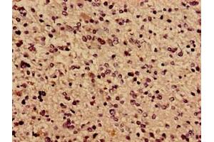 Immunocytochemistry analysis of human glioma using ABIN7171638 at dilution of 1:100 (TBC1D31 抗体  (AA 662-1001))