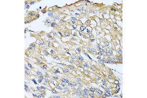 Immunohistochemistry of paraffin-embedded human prostate cancer using CCL8 antibody at dilution of 1:100 (40x lens). (CCL8 抗体)