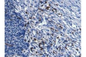 Detection of S100A8 in Human Ovarian cancer Tissue using Monoclonal Antibody to S100 Calcium Binding Protein A8 (S100A8) (S100A8 抗体  (AA 1-93))