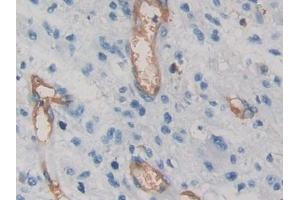 DAB staining on IHC-P; Samples: Human Glioma Tissue) (VEGFA 抗体  (AA 28-147))