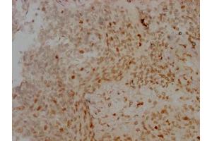 IHC image of ABIN7127357 diluted at 1:100 and staining in paraffin-embedded human cervical cancer performed on a Leica BondTM system. (Recombinant Aurora Kinase B 抗体)