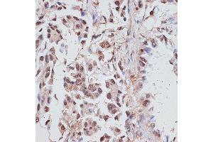 Immunohistochemistry of paraffin-embedded human lung cancer using RP/RP/RP antibody (ABIN6128653, ABIN6147083, ABIN6147084 and ABIN6214011) at dilution of 1:100 (40x lens). (RPA1 抗体  (AA 1-240))