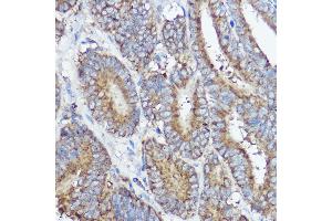 Immunohistochemistry of paraffin-embedded human colon carcinoma using  Rabbit pAb (ABIN7265359) at dilution of 1:50 (40x lens). (ABI1 抗体  (AA 180-230))