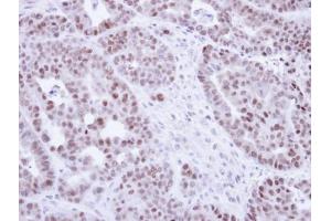 IHC-P Image Immunohistochemical analysis of paraffin-embedded NCIN87 Xenograft, using NR2C2, antibody at 1:100 dilution. (TR4 抗体)