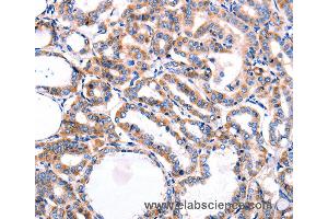 Immunohistochemistry of Human thyroid cancer using HDAC7 Polyclonal Antibody at dilution of 1:5 (HDAC7 抗体)