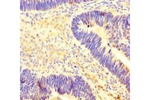 Immunohistochemistry of paraffin-embedded human ovarian cancer using ABIN7155449 at dilution of 1:100 (CARM1 抗体  (AA 209-379))