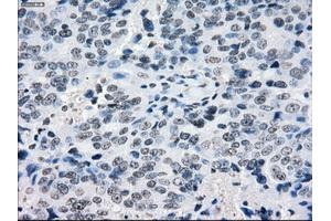 Immunohistochemical staining of paraffin-embedded Adenocarcinoma of colon tissue using anti-CRYABmouse monoclonal antibody. (CRYAB 抗体)