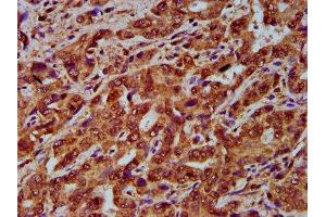 IHC image of ABIN7148830 diluted at 1:200 and staining in paraffin-embedded human liver cancer performed on a Leica BondTM system. (GARP 抗体  (AA 131-253))