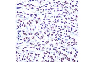 Immunohistochemistry of paraffin-embedded human esophageal cancer using DNA-PKcs Rabbit pAb (ABIN1513422, ABIN3021956 and ABIN3021957) at dilution of 1:100 (40x lens). (PRKDC 抗体)