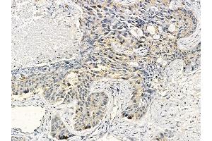 Cytokeratin 16 Mouse Monoclonal Antibody at 1/100 staining human lung cancer and adjacent non-tumor tissue by IHC-P. (KRT16 抗体  (C-Term))