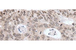 Immunohistochemistry of paraffin-embedded Human colorectal cancer tissue using HIST1H3A Polyclonal Antibody at dilution of 1:35(x200) (HIST1H3A 抗体)