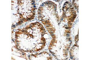 Anti-SQSTM1/p62 antibody, IHC(P) IHC(P): Human Intestinal Cancer Tissue (SQSTM1 抗体  (N-Term))