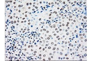 Immunohistochemical staining of paraffin-embedded Adenocarcinoma of colon tissue using anti-RAD9Amouse monoclonal antibody. (RAD9A 抗体)
