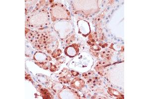 Immunohistochemistry of paraffin-embedded human thyroid cancer using S100 antibody (ABIN7270126) at dilution of 1:100 (40x lens). (S100A5 抗体  (AA 1-92))