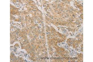 Immunohistochemistry of Human gastric cancer using ACSL4 Polyclonal Antibody at dilution of 1:60 (ACSL4 抗体)