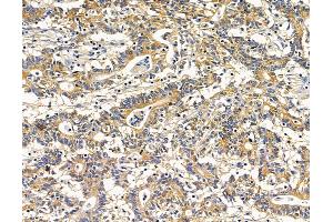 ABIN7095945 and ABIN7100007 at 1/100 staining human colorectal cancer by IHC-P. (RASGRP4 抗体)