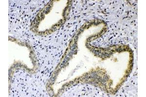 IHC testing of FFPE human breast cancer tissue with TNFSF18 antibody at 1ug/ml. (TNFSF18 抗体)