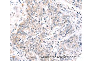 Immunohistochemistry of Human prostate cancer using ROR1 Polyclonal Antibody at dilution of 1:45 (ROR1 抗体)