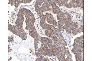 IHC-P Image Immunohistochemical analysis of paraffin-embedded human gastric cancer, using survivin , antibody at 1:100 dilution. (Survivin 抗体  (C-Term))