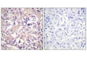 Immunohistochemistry analysis of paraffin-embedded human breast carcinoma tissue using TK (Ab-13) antibody. (TK1 抗体  (Ser13))