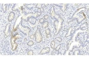 Immunohistochemical analysis of paraffin-embedded Human Lung adenocarcinoma section using Pink1 (ABIN6243980 and ABIN6577274). (ROS1 抗体)