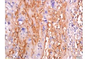 Formalin-fixed and paraffin embedded human colon carcinoma tissue labeled with Anti-sFRP-4 Polyclonal Antibody, Unconjugated  at 1:200 followed by conjugation to the secondary antibody and DAB staining. (SFRP4 抗体  (AA 151-260))