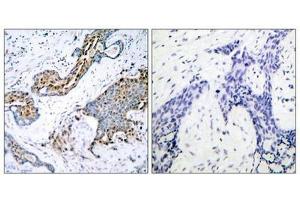 Immunohistochemical analysis of paraffin-embedded human breast carcinoma tissue using Estrogen Receptor-a(Phospho-Ser118) Antibody(left) or the same antibody preincubated with blocking peptide(right). (Estrogen Receptor alpha 抗体  (pSer118))