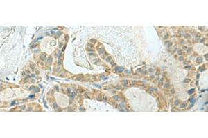 Immunohistochemistry of paraffin-embedded Human thyroid cancer tissue using KLC2 Polyclonal Antibody at dilution of 1:120(x200) (KLC2 抗体)