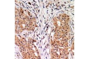 Immunohistochemical analysis of RhoGDI alpha staining in human breast cancer formalin fixed paraffin embedded tissue section. (ARHGDIA 抗体  (C-Term))