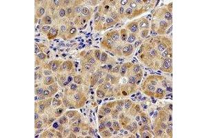 Immunohistochemical analysis of UQCR10 staining in human liver cancer formalin fixed paraffin embedded tissue section. (UQCR10 抗体)