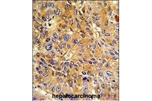 Formalin-fixed and paraffin-embedded human hepatocarcinoma with Cyclin A (CCNA2) Antibody (N-term), which was peroxidase-conjugated to the secondary antibody, followed by DAB staining. (Cyclin A 抗体  (N-Term))