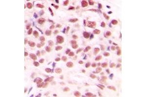 Immunohistochemical analysis of c-Myc (pS62) staining in human breast cancer formalin fixed paraffin embedded tissue section.