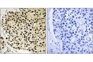 Immunohistochemistry analysis of paraffin-embedded human breast carcinoma, using NFAT3 (Phospho-Ser168+Ser170) Antibody. (NFATC4 抗体  (pSer168))