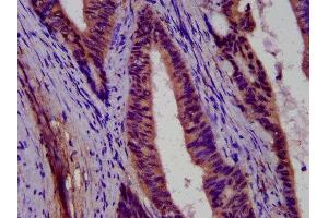 IHC image of ABIN7166555 diluted at 1:500 and staining in paraffin-embedded human colon cancer performed on a Leica BondTM system. (PCDH11X 抗体  (AA 987-1117))