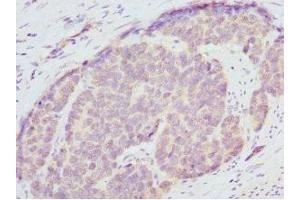 Immunohistochemistry of paraffin-embedded human gastric cancer using ABIN7151362 at dilution of 1:100 (ENOX2 抗体  (AA 411-610))