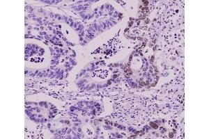 Paraffin embedded sections of colorectal canitrocelluloseer tissue were initrocelluloseubated with anti-human SUMO2/3 antibody (1:50) for 2 hours at room temperature. (SUMO2 抗体  (AA 1-93))