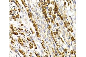 Immunohistochemistry of paraffin-embedded Human stomach cancer using TACR3 Polyclonal Antibody at dilution of 1:100 (40x lens). (TACR3 抗体)