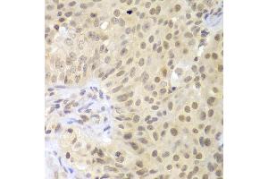 Immunohistochemistry of paraffin-embedded human oophoroma using LHX4 antibody at dilution of 1:100 (x400 lens). (LHX4 抗体)