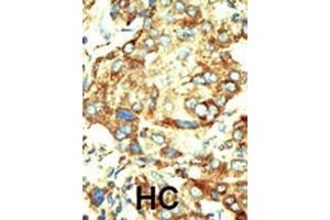 Formalin-fixed and paraffin-embedded human cancer tissue reacted with the primary antibody, which was peroxidase-conjugated to the secondary antibody, followed by DAB staining. (Dnmt2 抗体  (AA 346-375))