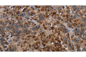 Immunohistochemistry of paraffin-embedded Human liver cancer using MAP3K11 Polyclonal Antibody at dilution of 1:40 (MAP3K11 抗体)
