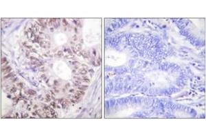 Immunohistochemistry analysis of paraffin-embedded human colon carcinoma, using CDC25C (Phospho-Thr48) Antibody. (CDC25C 抗体  (pThr48))