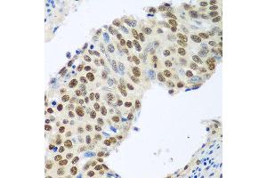 Immunohistochemistry of paraffin-embedded human lung cancer using MDC1 antibody at dilution of 1:100 (40x lens). (MDC1 抗体)