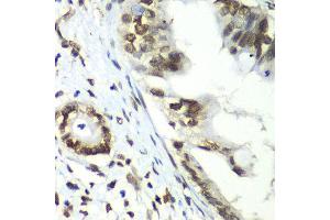 Immunohistochemistry of paraffin-embedded human liver cancer using TEAD1 antibody at dilution of 1:100 (x40 lens).