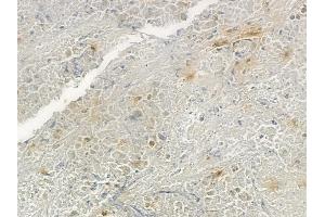ABIN6266259 and ABIN6277418 at 1/100 staining human lung squamous cell carcinoma by IHC-P. (P2RY4 抗体  (C-Term))