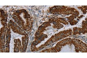 Immunohistochemistry of paraffin-embedded Human esophagus cancer using HSD17B2 Polyclonal Antibody at dilution of 1:50 (HSD17B2 抗体)
