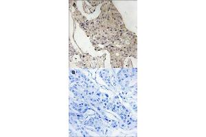 Immunohistochemical staining of human breast carcinoma tissue by GAB2 (phospho S623) polyclonal antibody  without blocking peptide (A) or preincubated with blocking peptide (B) under 1:50-1:100 dilution. (GAB2 抗体  (pSer623))